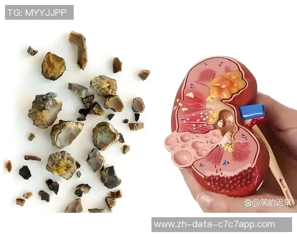 肾结石足球：探讨运动对肾结石患者的影响与预防措施